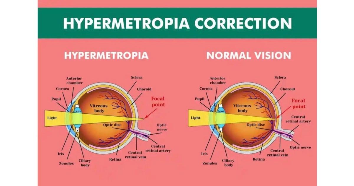 Hypermetropia (long-sightedness or far-sightedness)