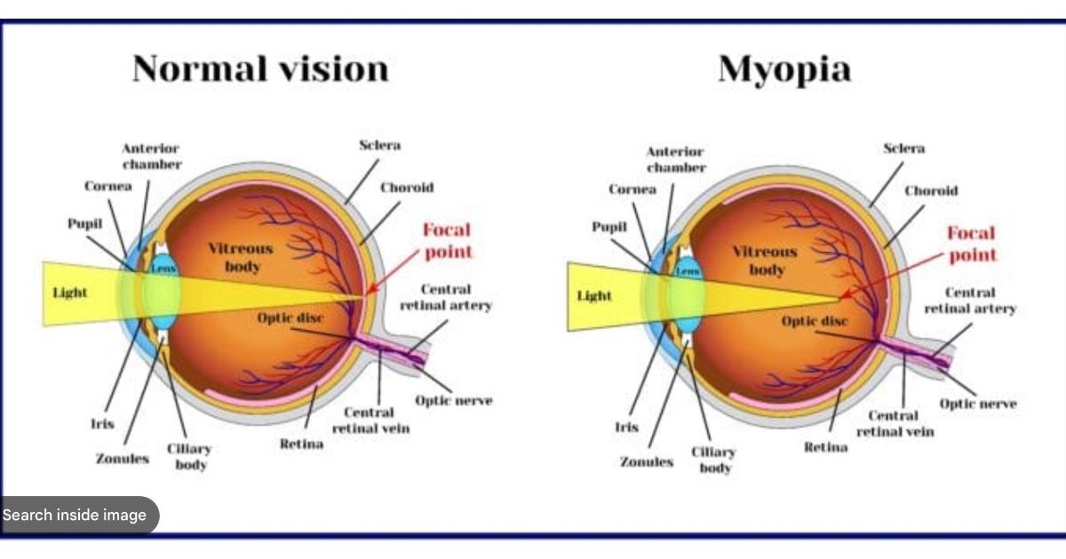 Myopia (Nearightedness)