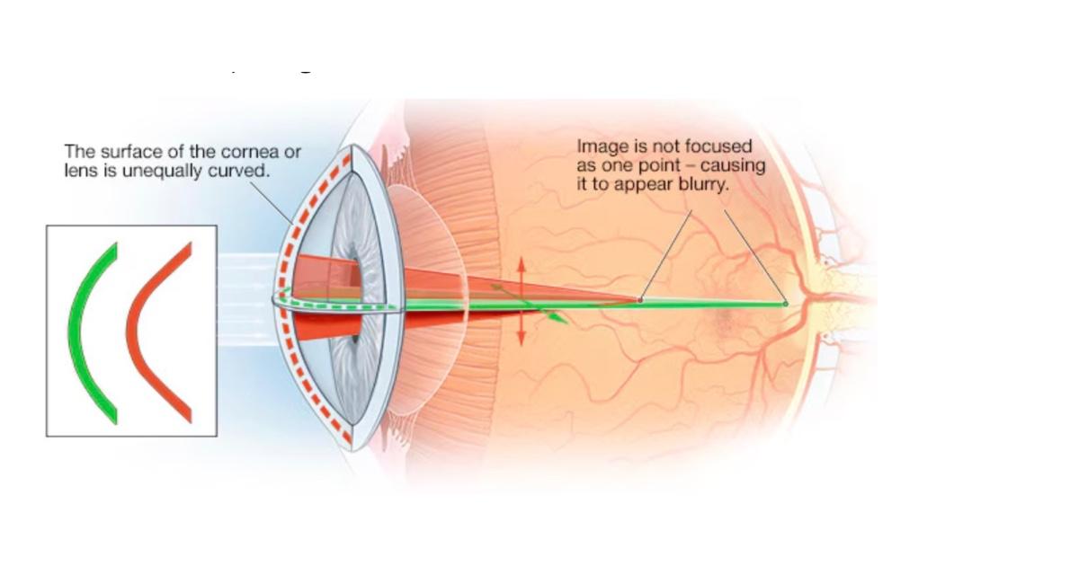Astigmatism