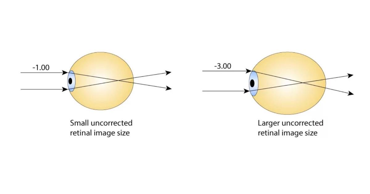 Anisometropia