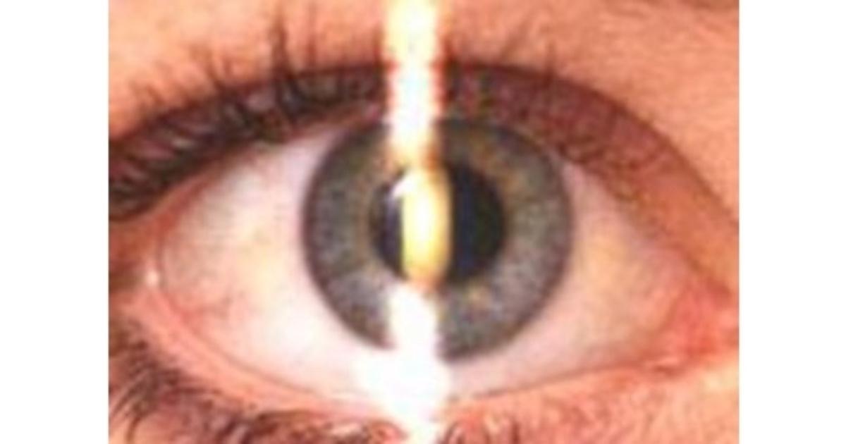 Retinoscope