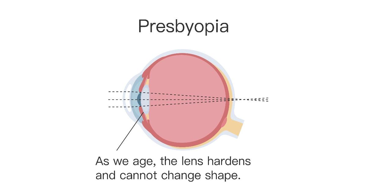 Presbyopia